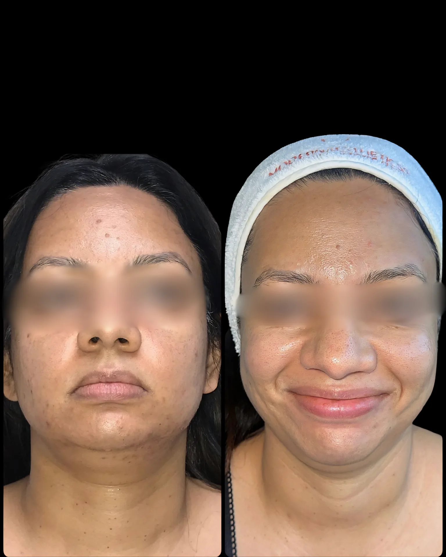 Befoure and After