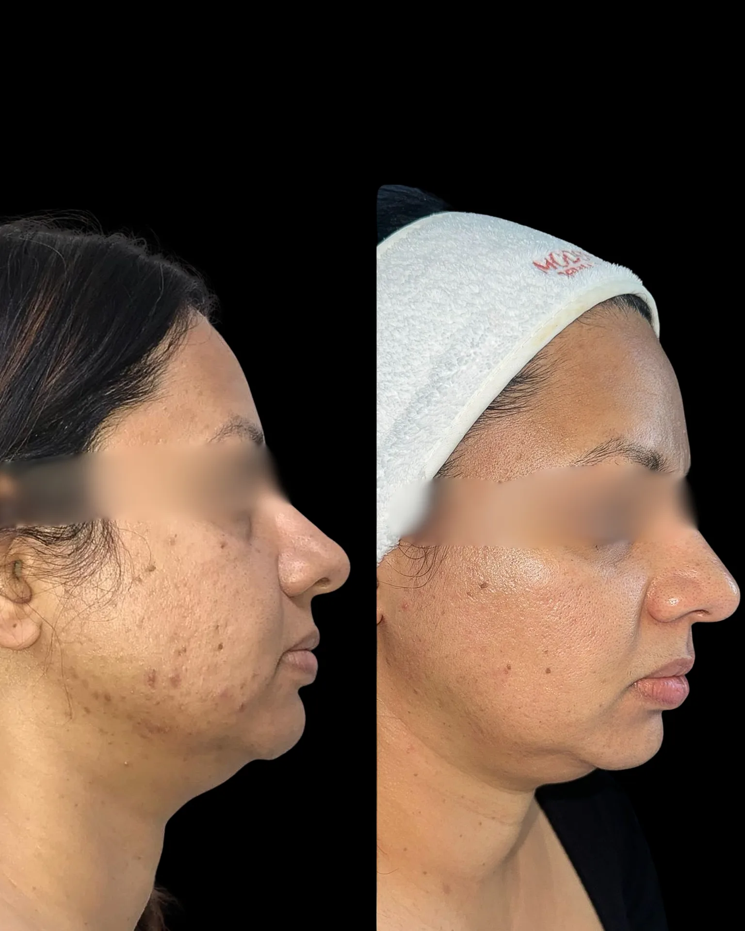 Befoure and After
