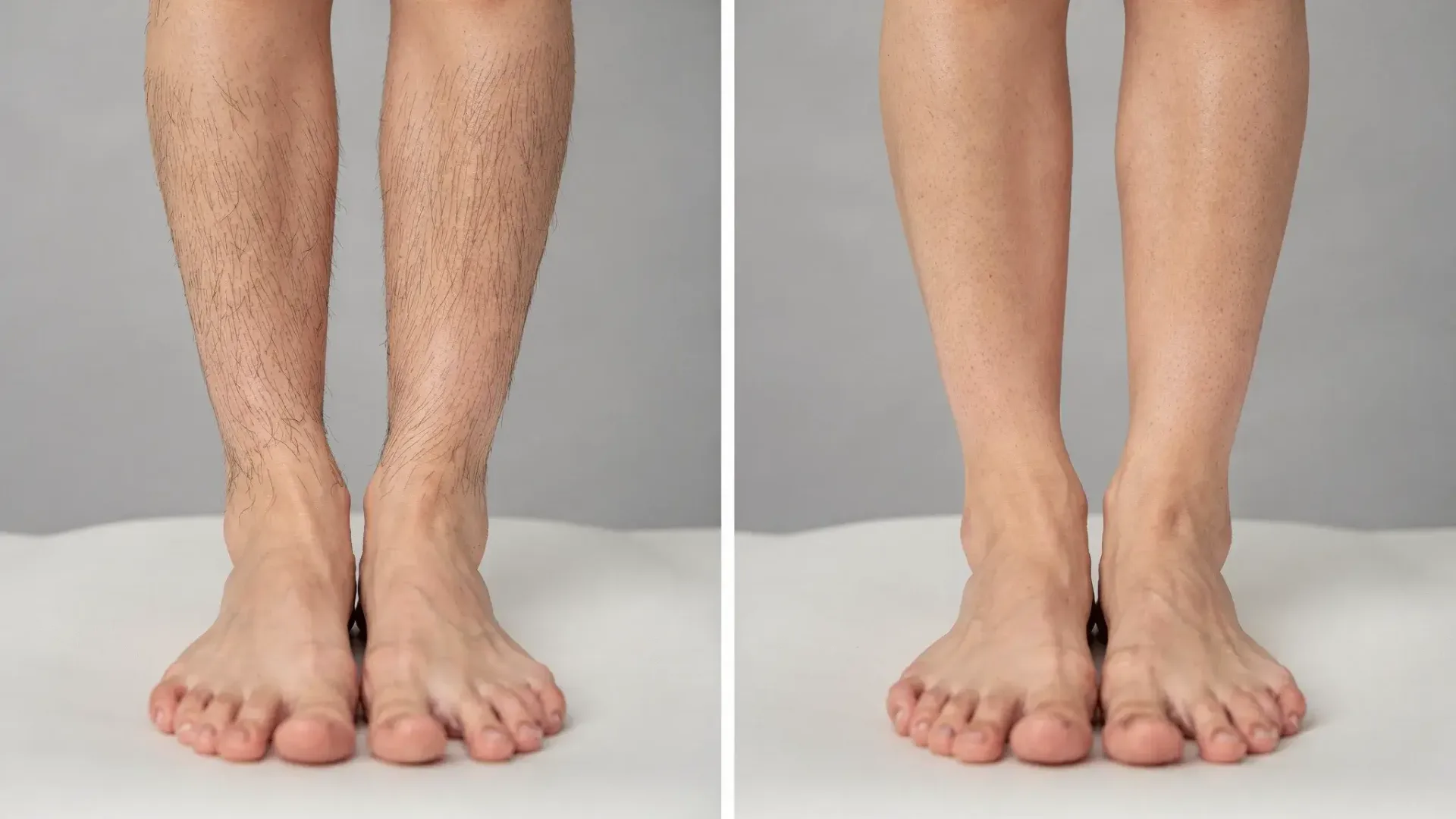 A tasteful clinic style before and after: lower legs shown from knee to ankle, left image with visible dark hair, right image after a complete laser series with significantly reduced hair density and smoother skin tone, same lighting and pose.