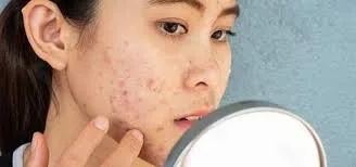 Acne on Cheeks: Causes, Treatment and How to Clear It for Good