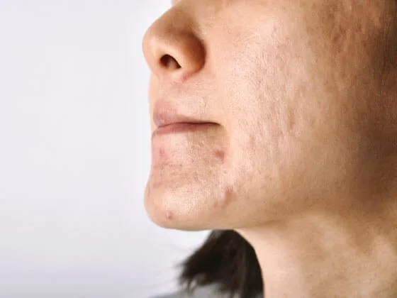 What Is Microneedling RF?