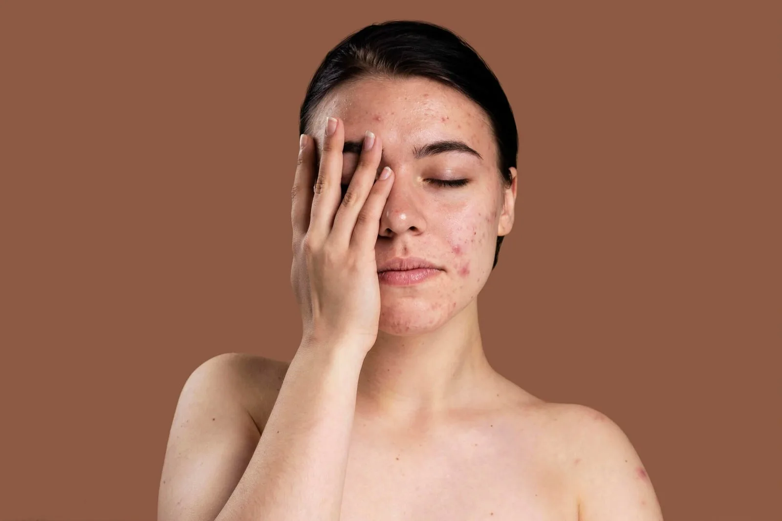 when to see dermatologist for acne treatment