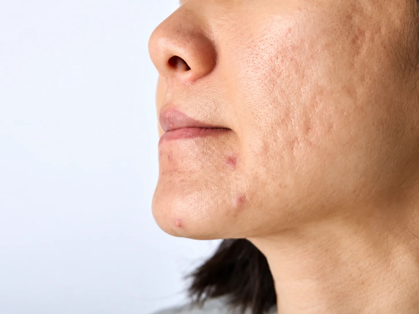 What Is PRP/ PRF?