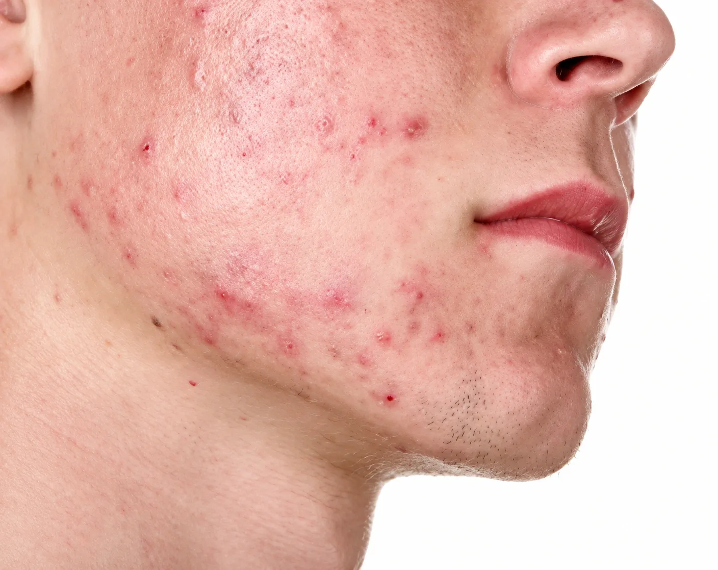 What Conditions Can Subcision Treat?