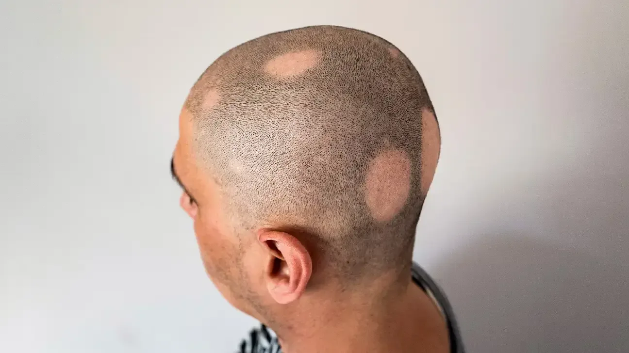 Alopecia: Causes, Symptoms, and Effective Treatments