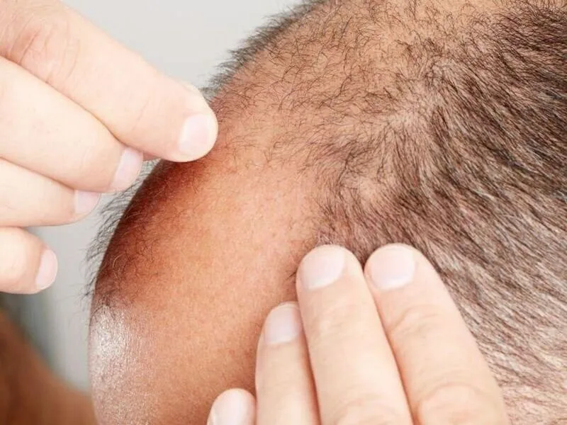 Hair loss