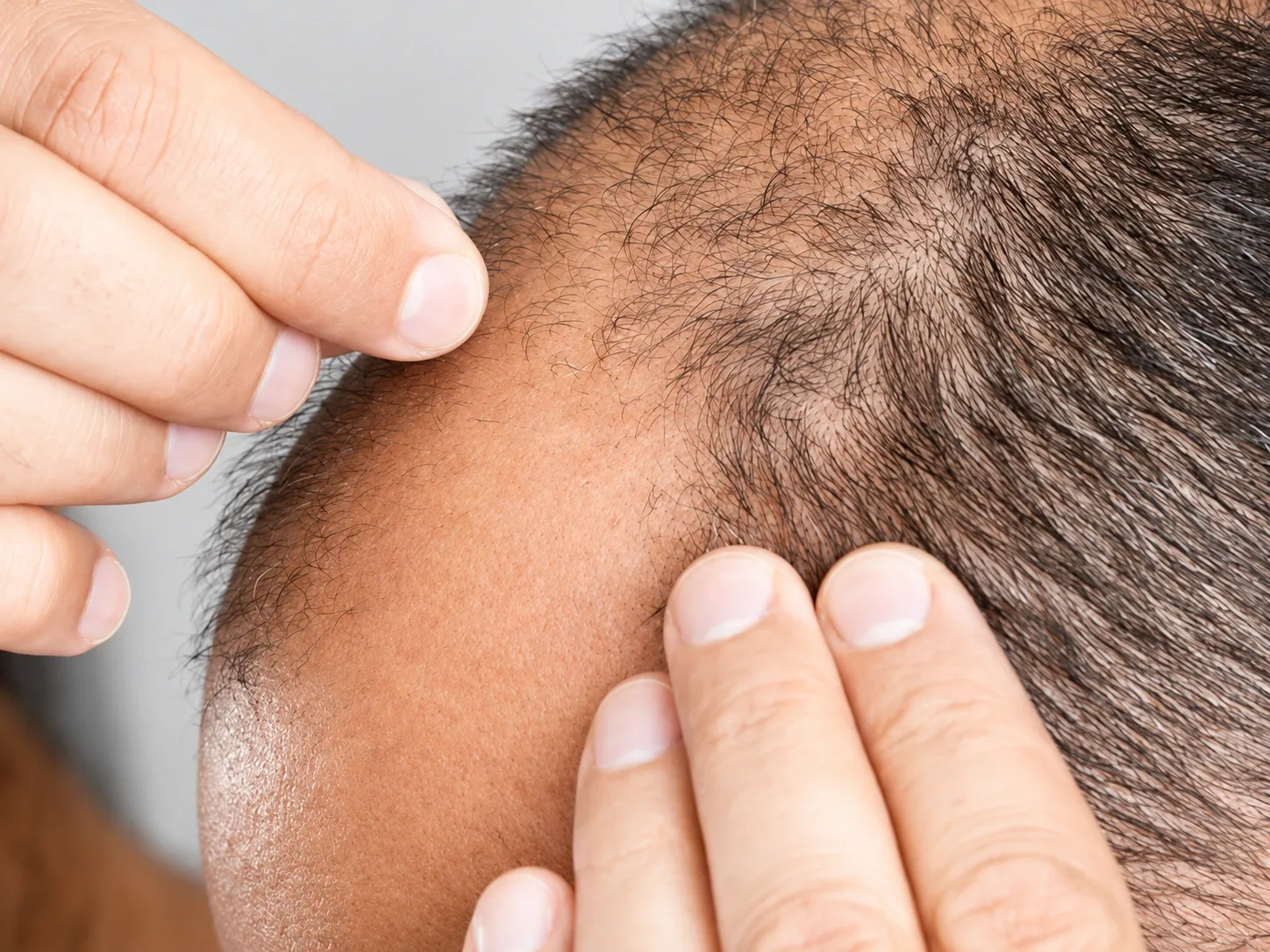 Who Experiences Hair Loss & Why?