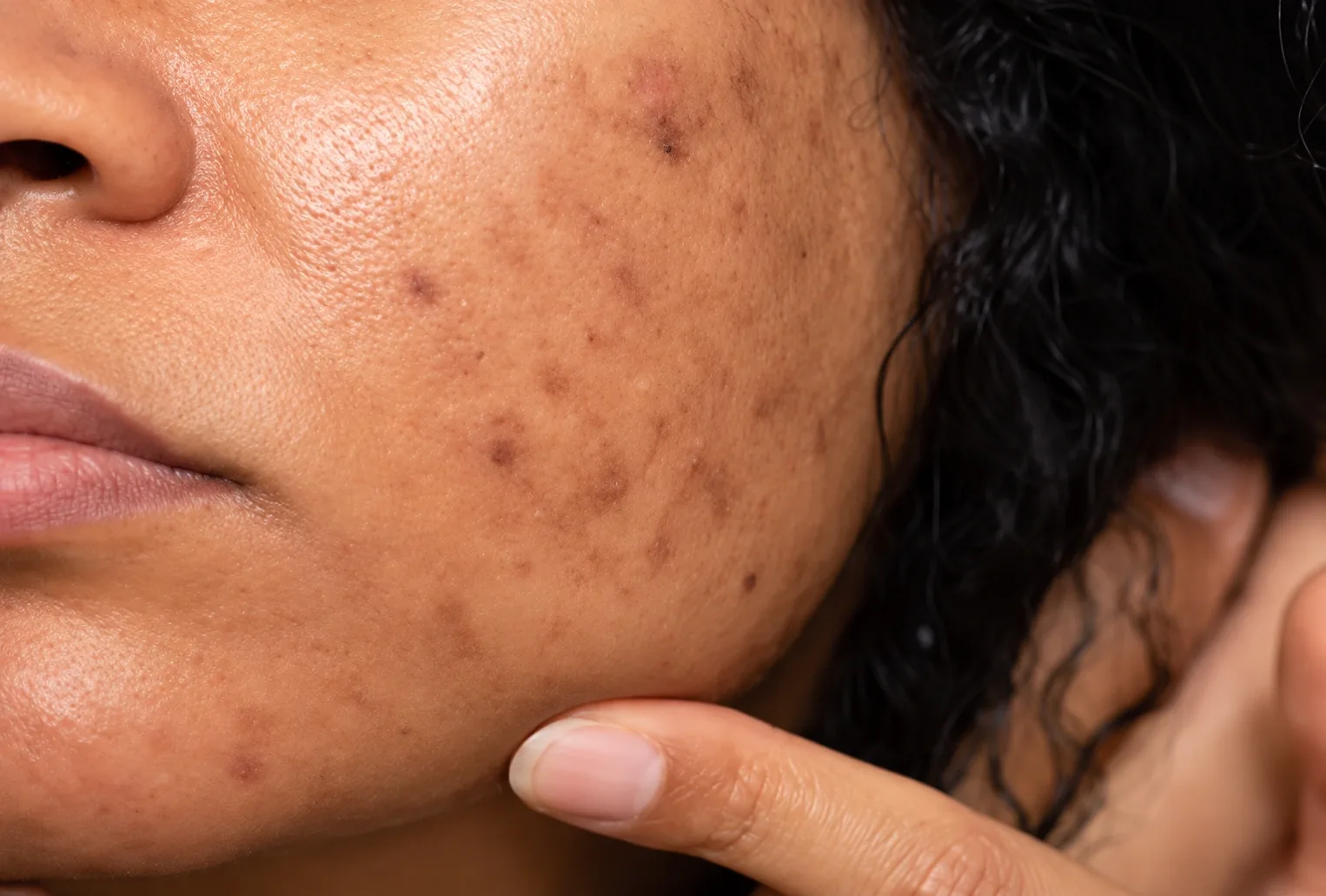What Is Lumenis Pollogen OxyGeneo?
