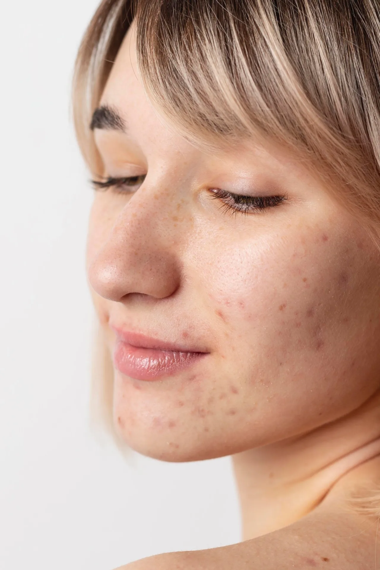 IPL vs Laser Treatment for Pigmentation Removal