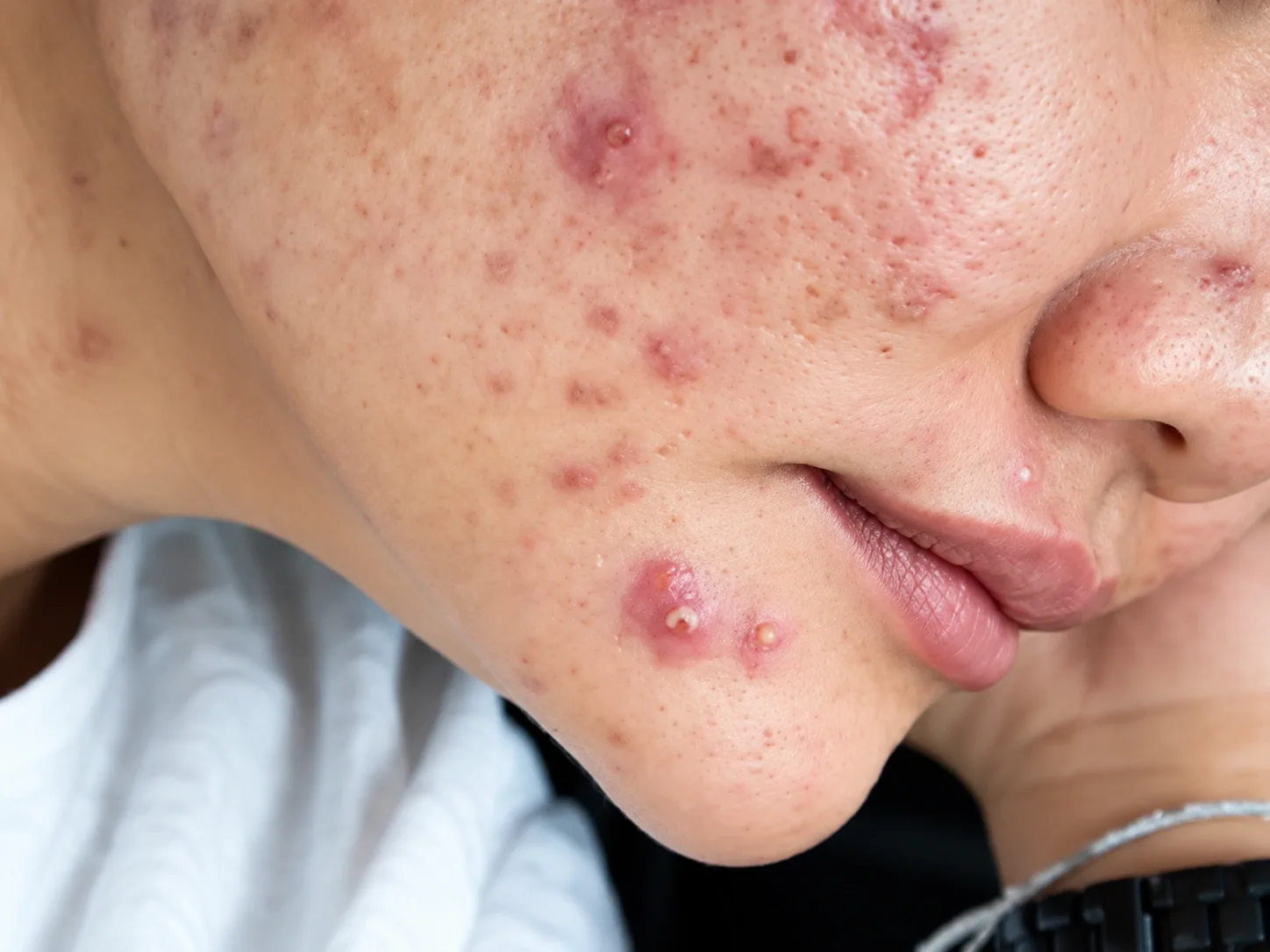Understanding the root cause is key to effective and lasting acne control.