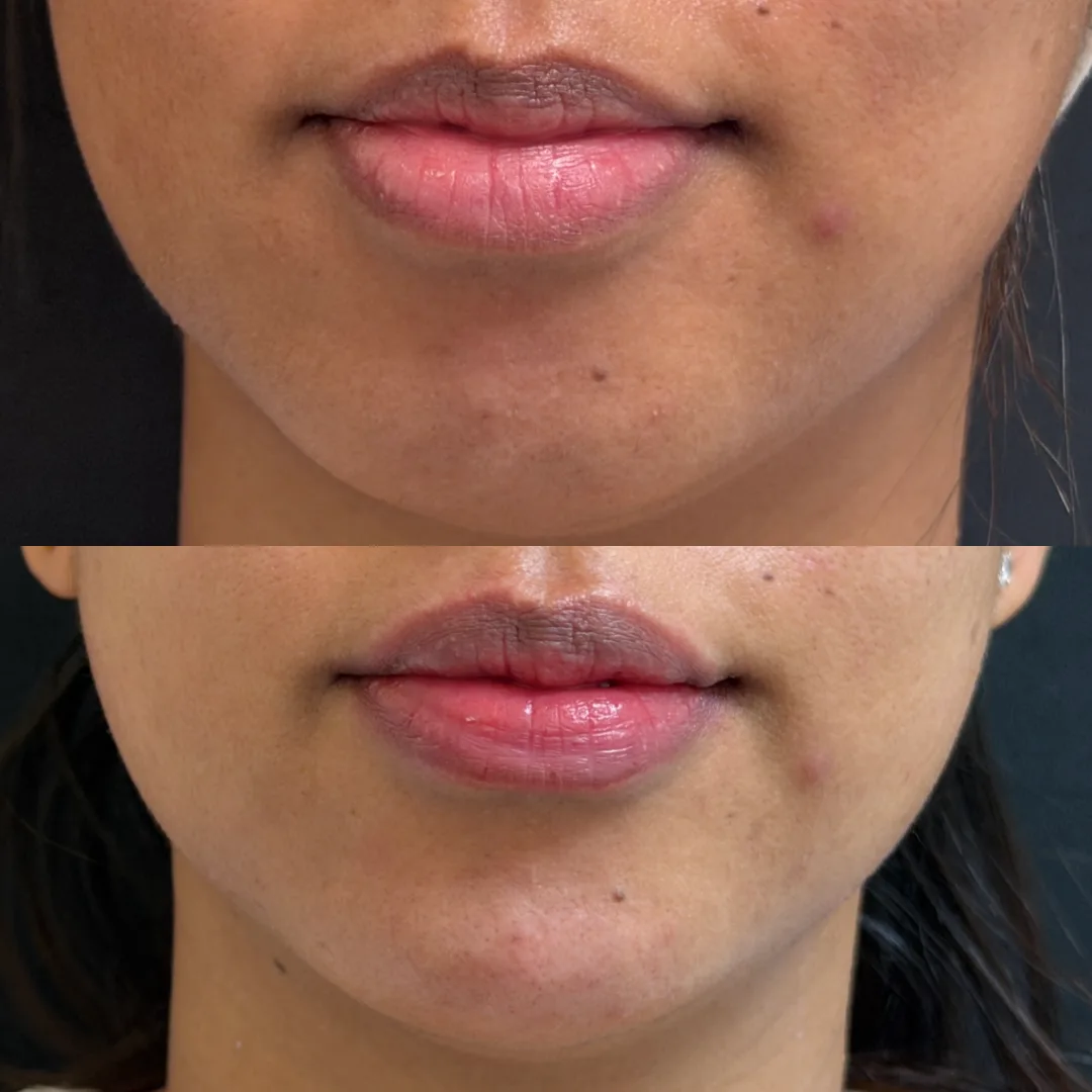 Befoure and After
