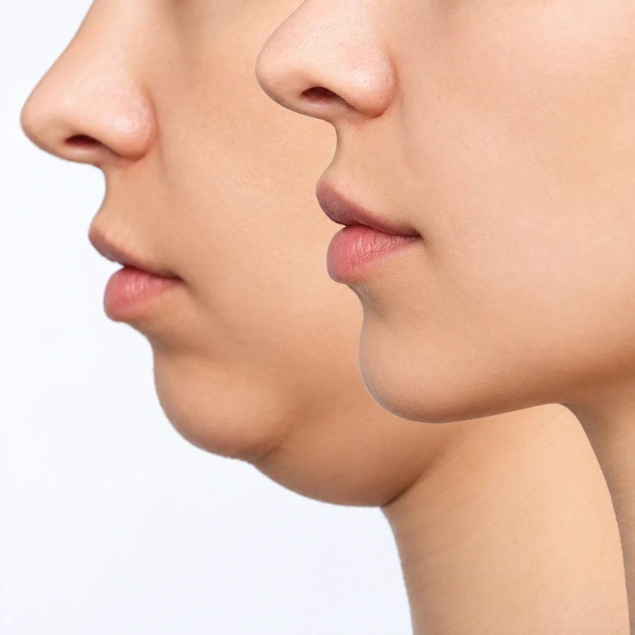 Injection Lipolysis Treatment in Dubai