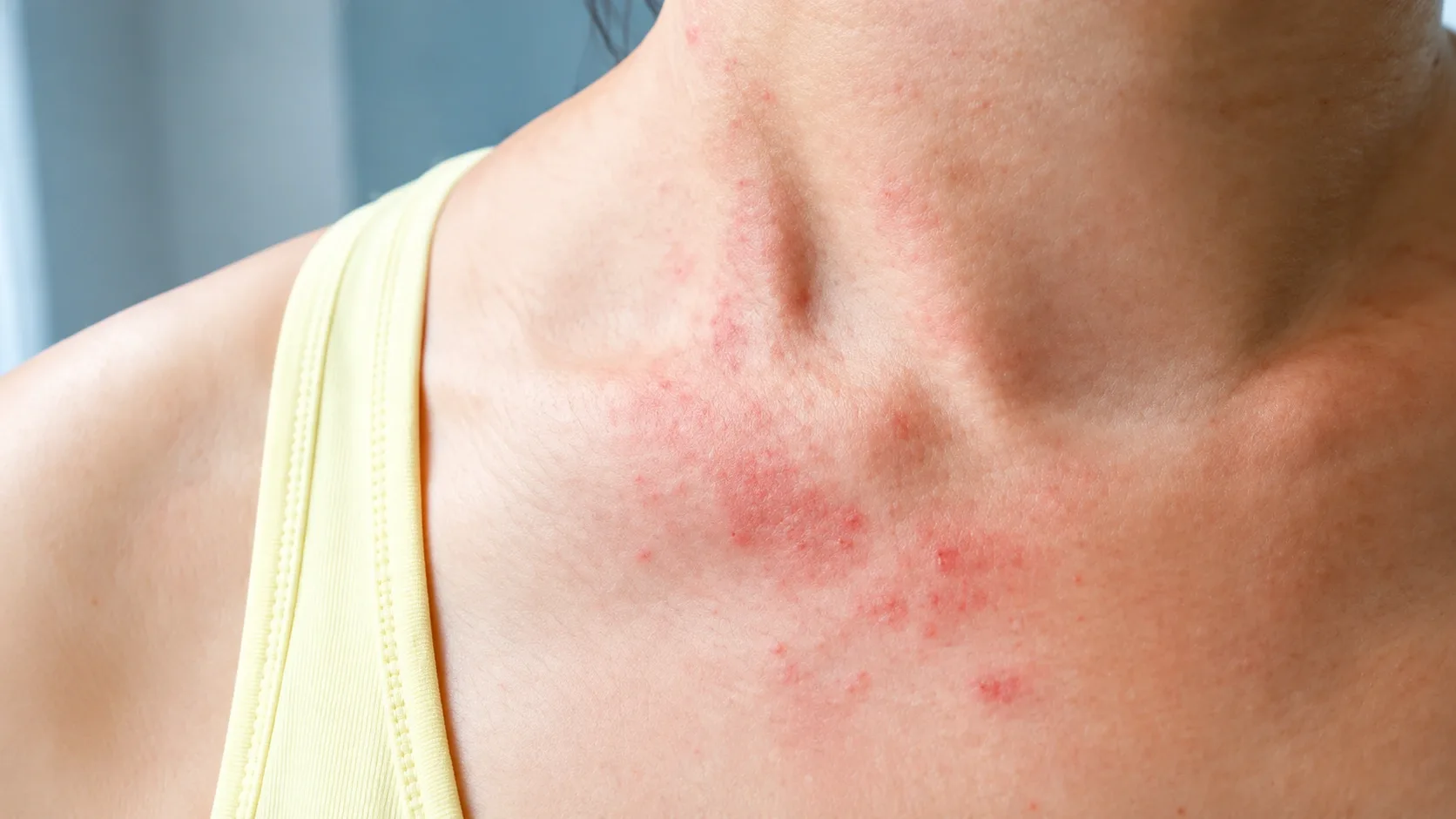 Eczema Treatment Dubai