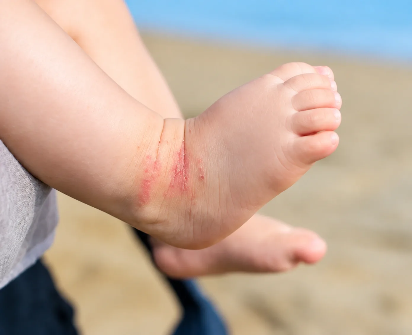 What Causes Eczema and Why It Develops?