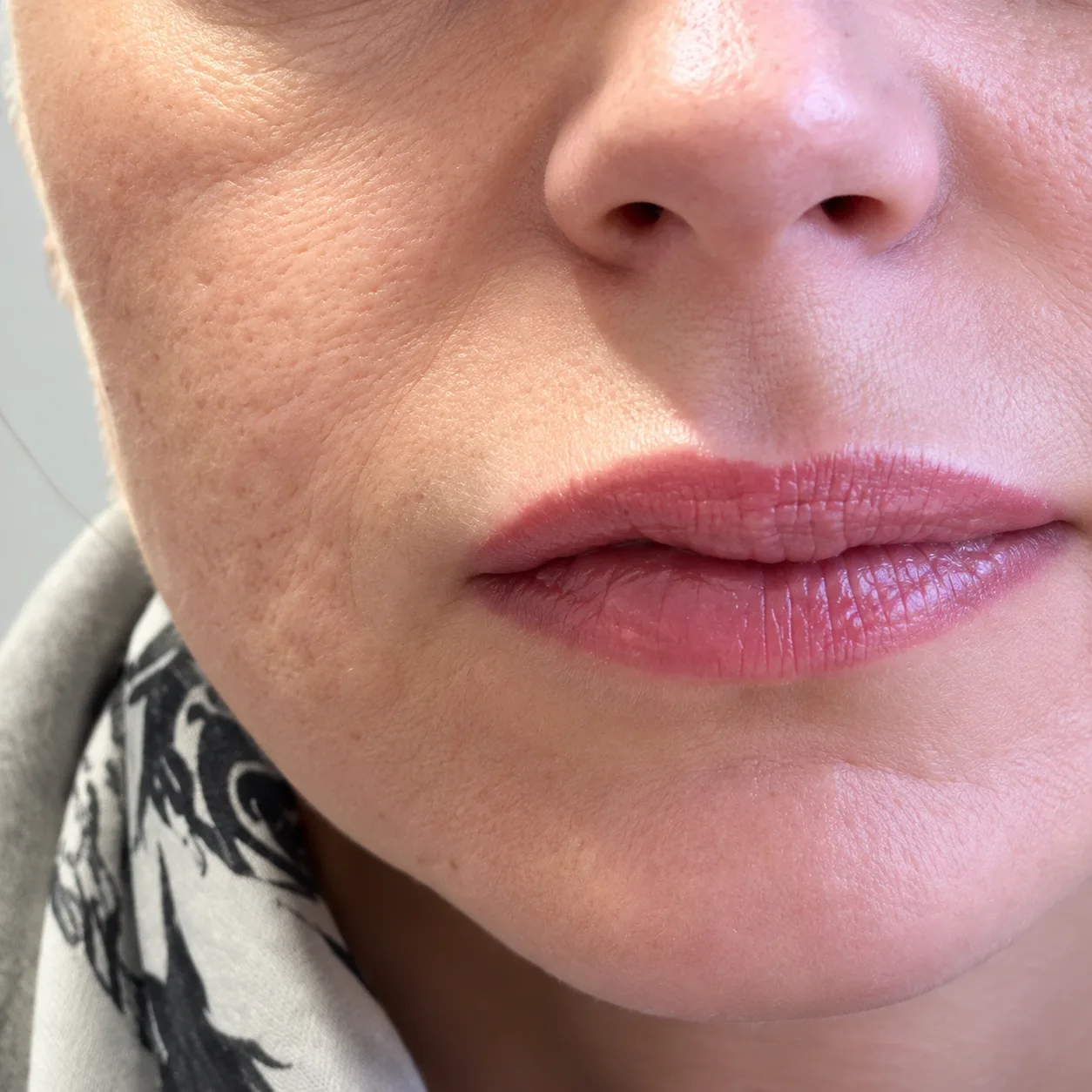 Hyaluronidase Filler Dissolving in Dubai