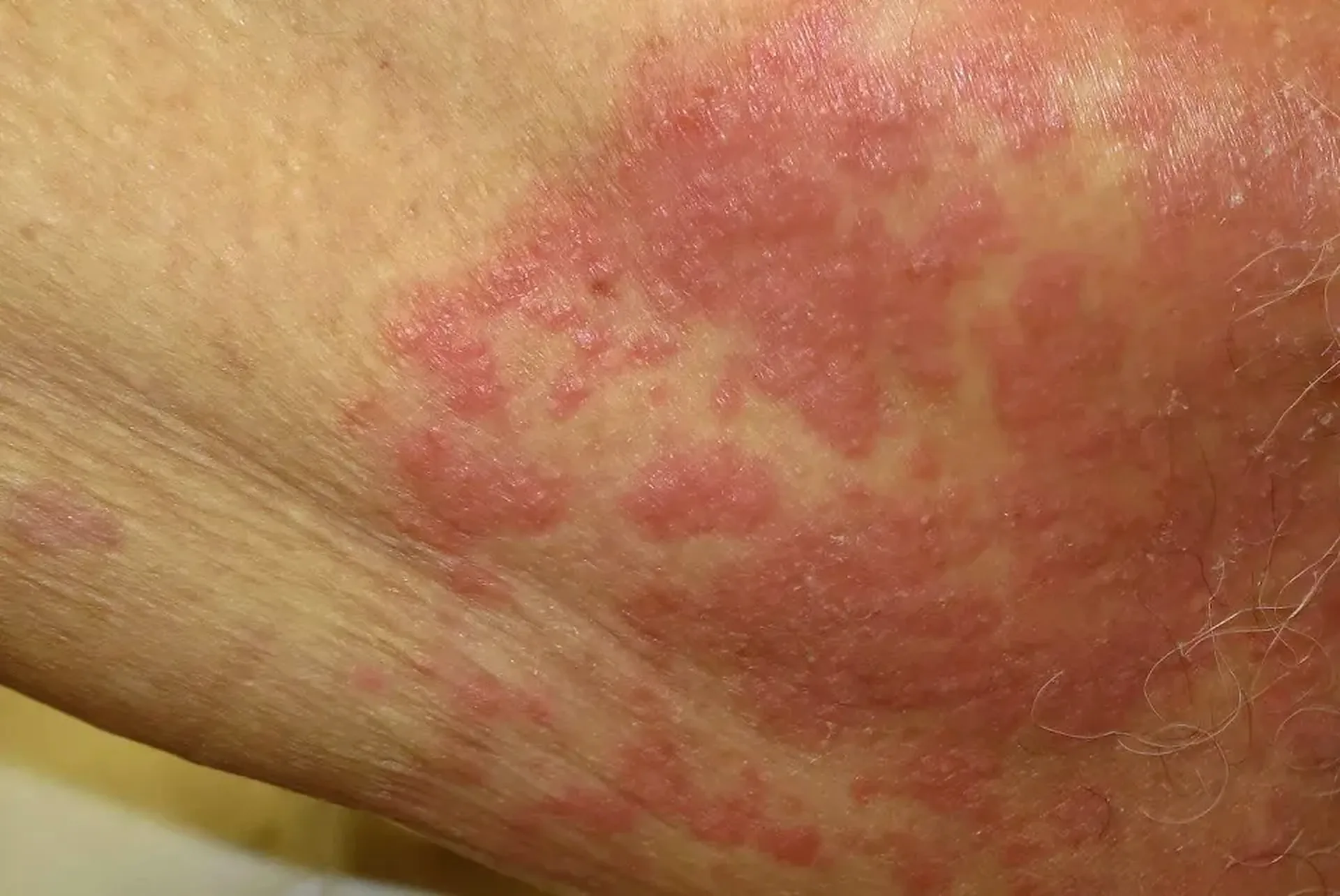 Fungal Infection Treatment in Dubai