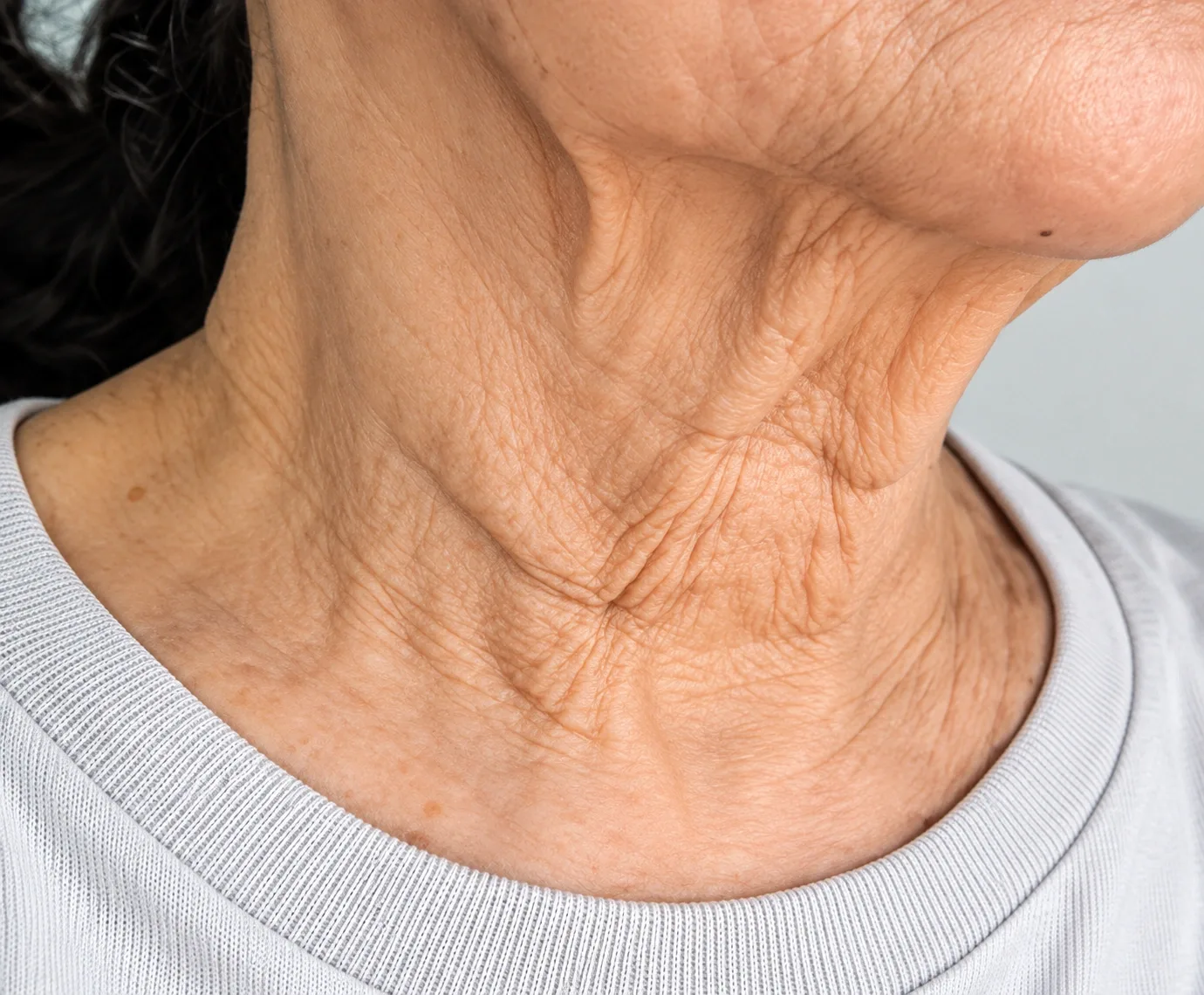 HIFU Treatment in Dubai