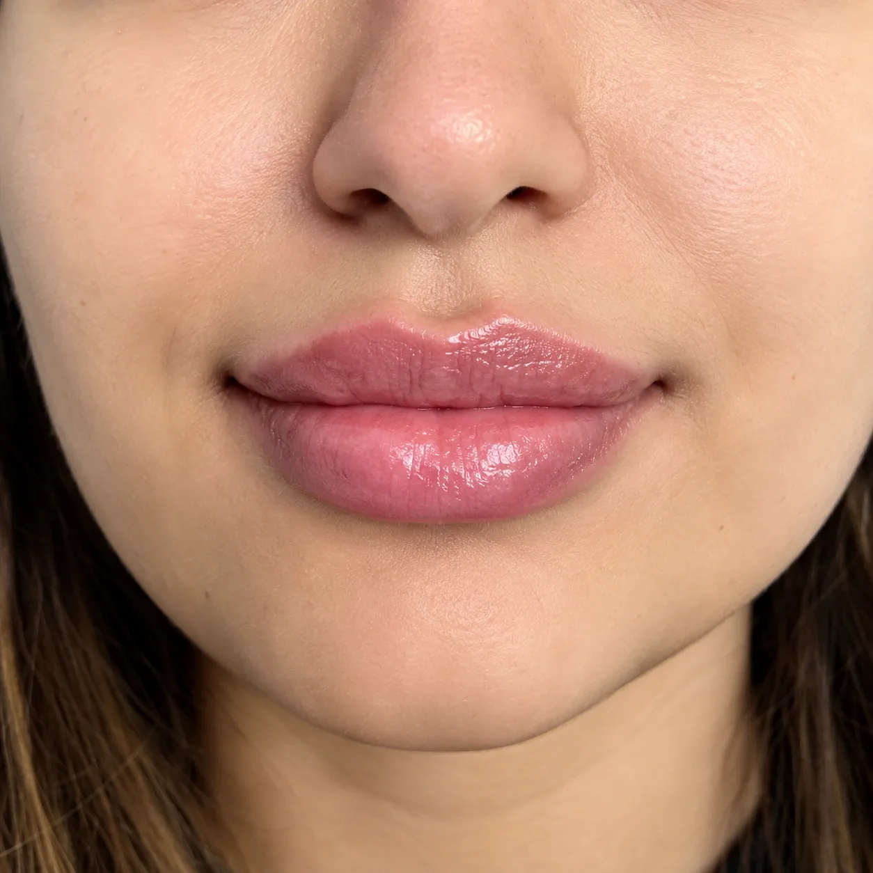 Who Needs Filler Dissolving?