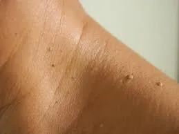 treatment