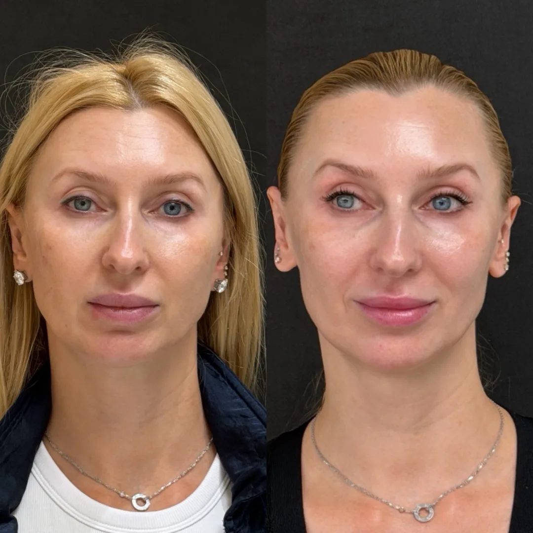 Result — treatment result