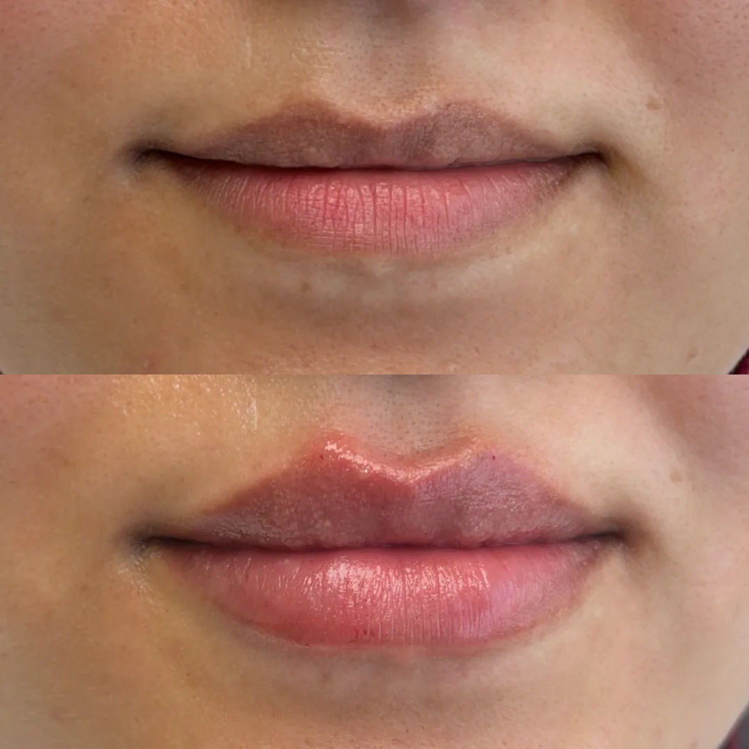 Befoure and After