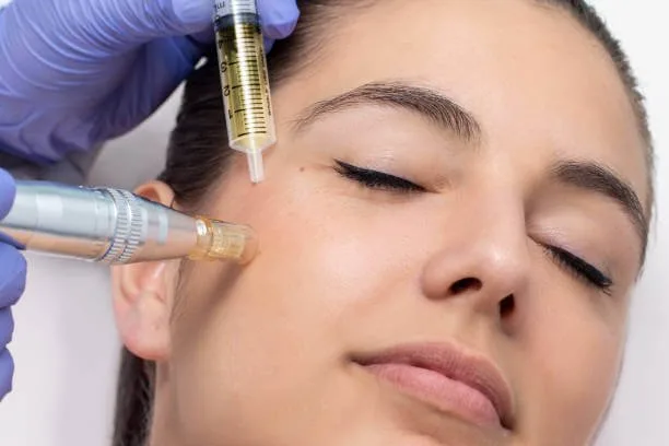 Microneedling in Dubai
