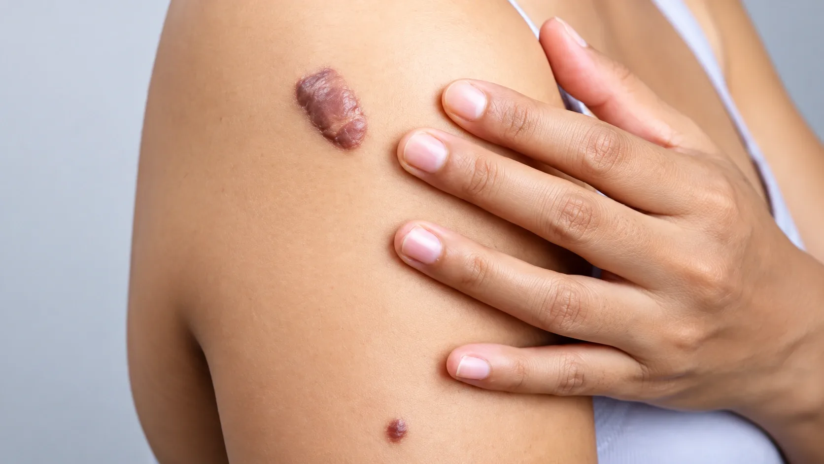 Keloid Scar Treatment Dubai