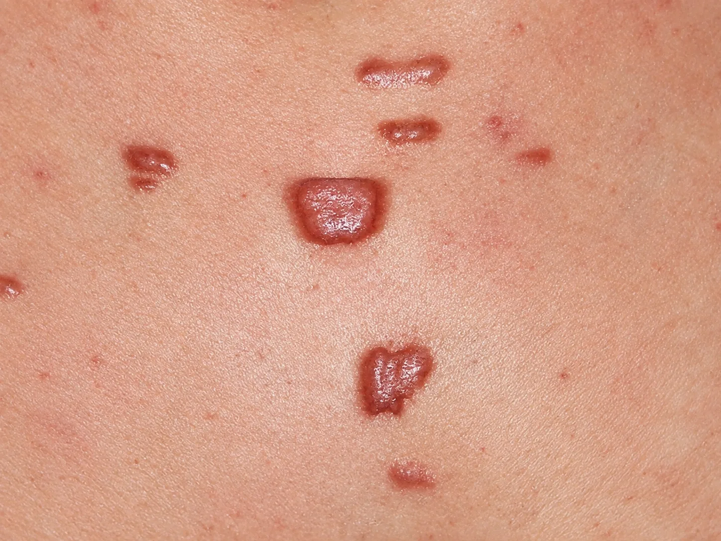 Common Symptoms of Keloids