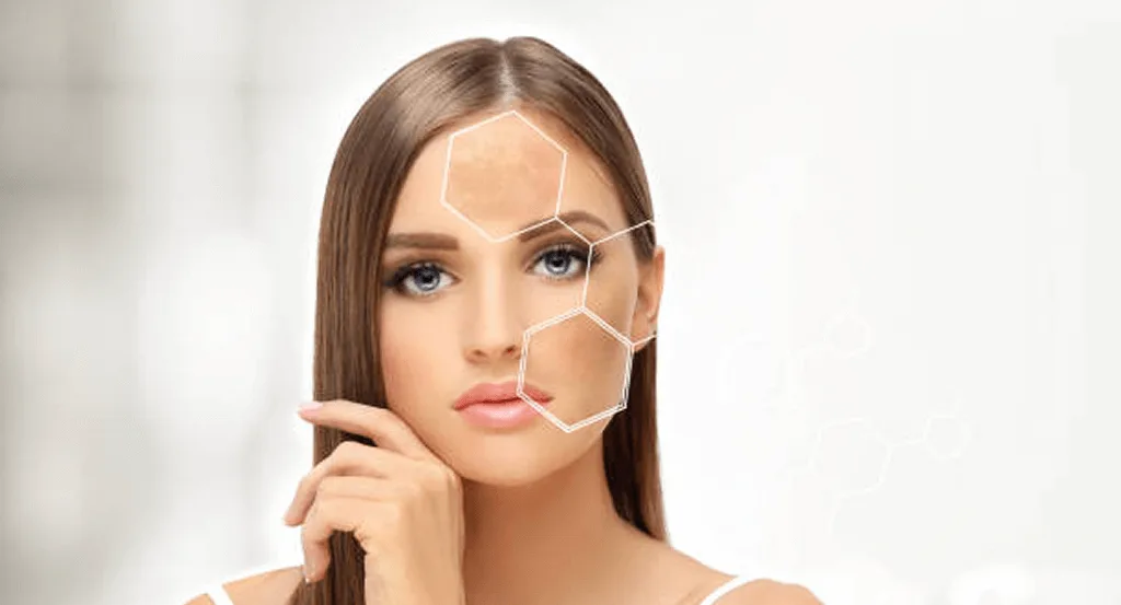 Why Is Melasma So Hard to Treat and How Does the Cosmelan Peel Help?
