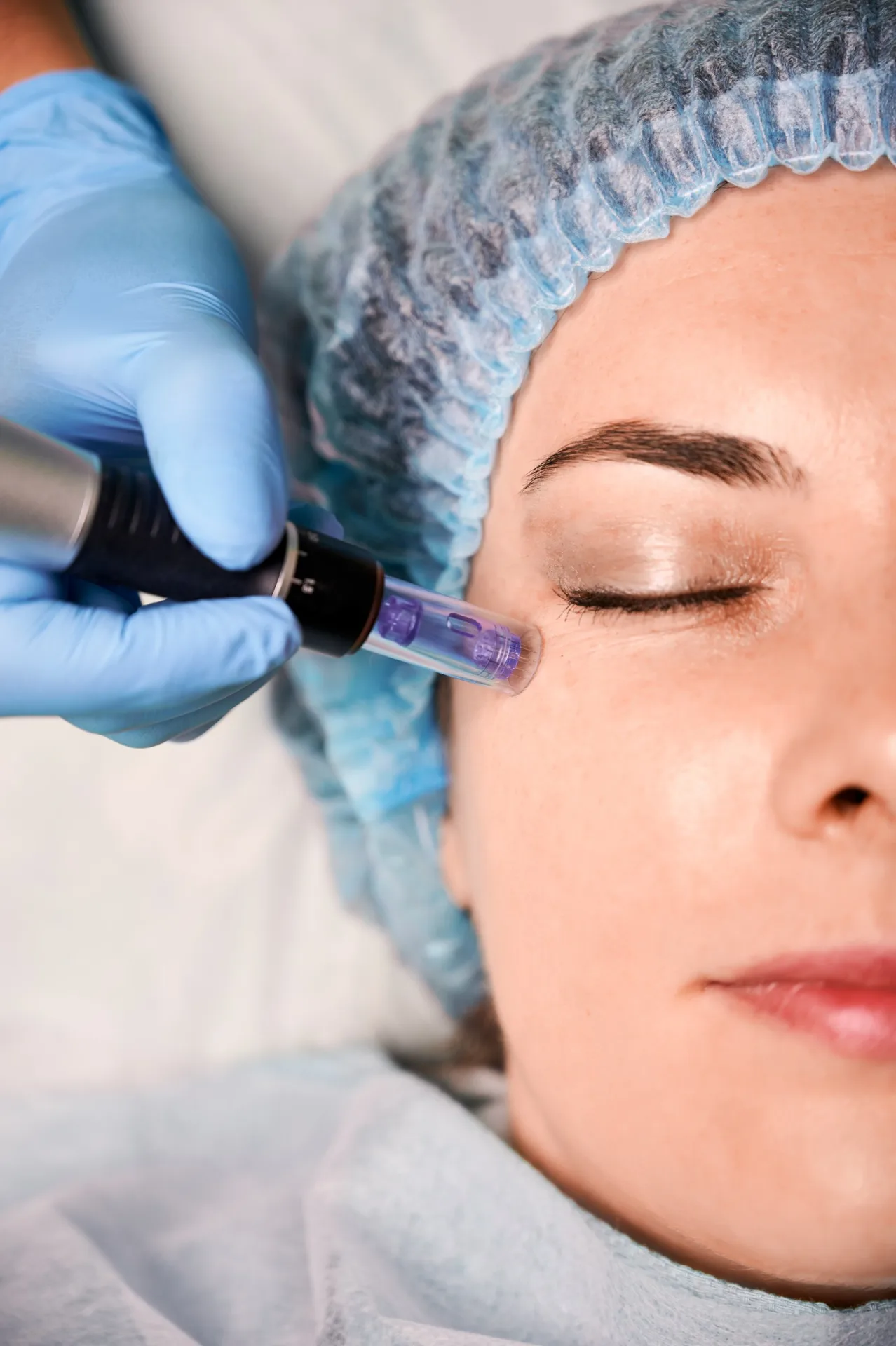 Exploring the Various Types of Microneedling Treatments