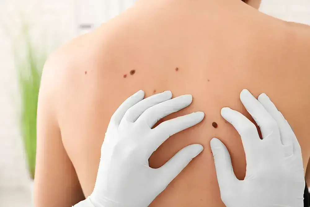 Understanding Mole Mapping: The Modern Way to Track Skin Health