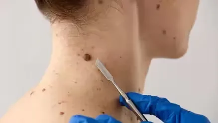 Mole Removal: Everything You Need to Know About Safe & Effective Treatments