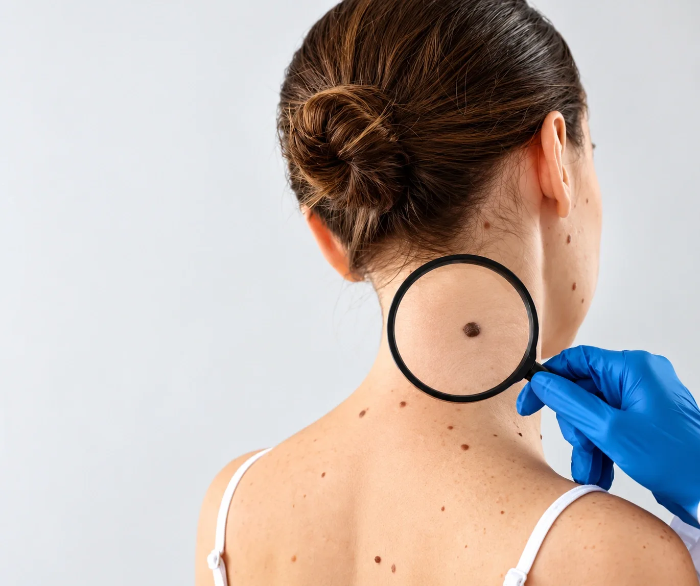 Mole Mapping Treatment in Dubai