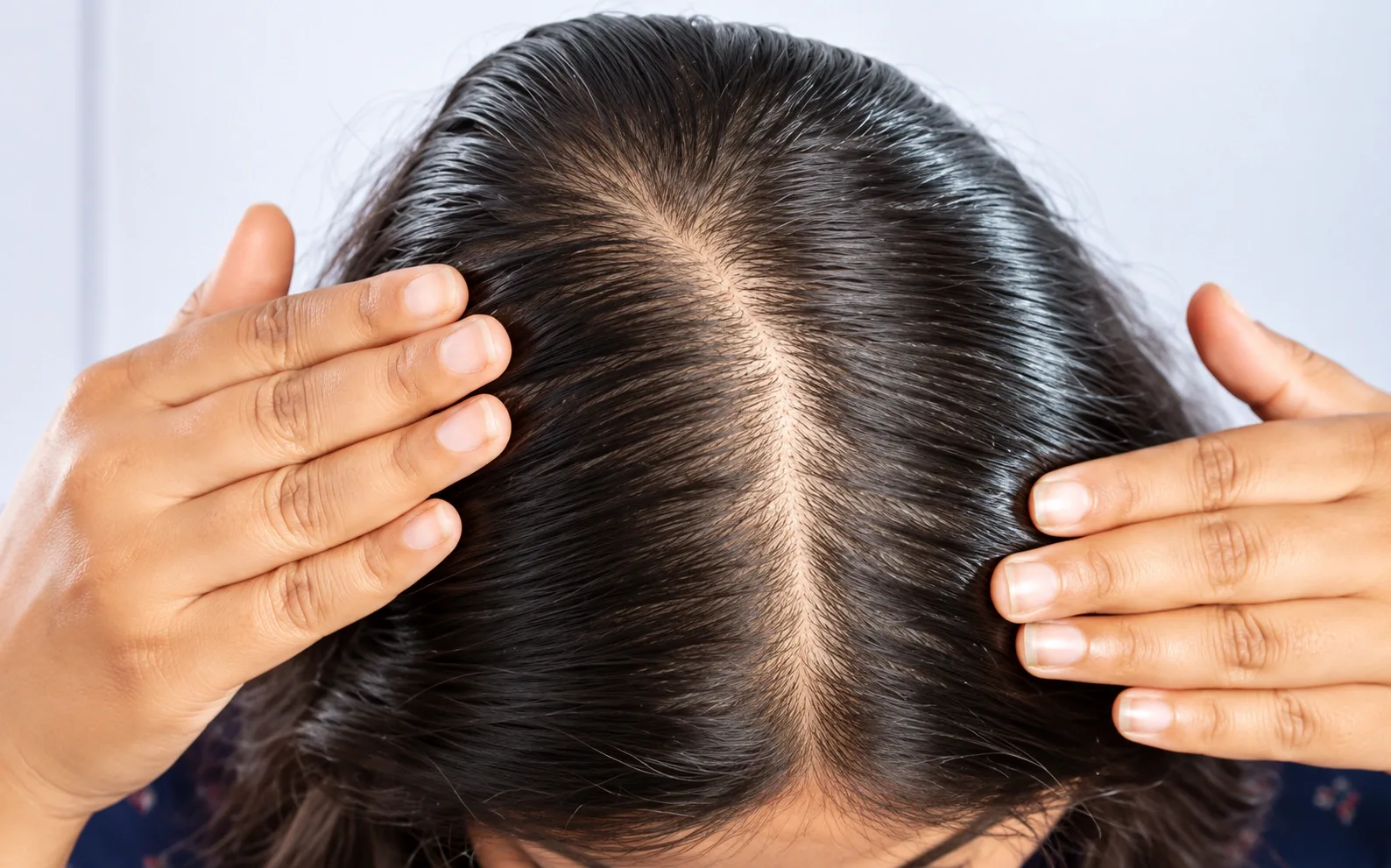 Hair Loss Treatment Dubai