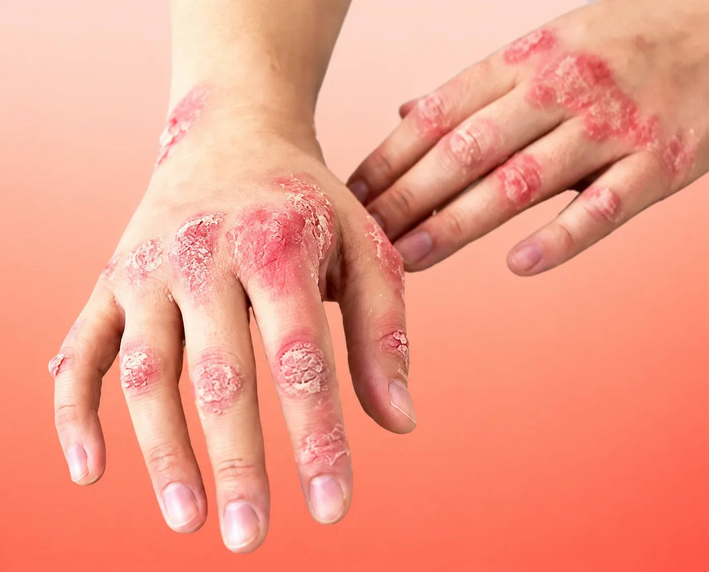 What Causes Psoriasis?