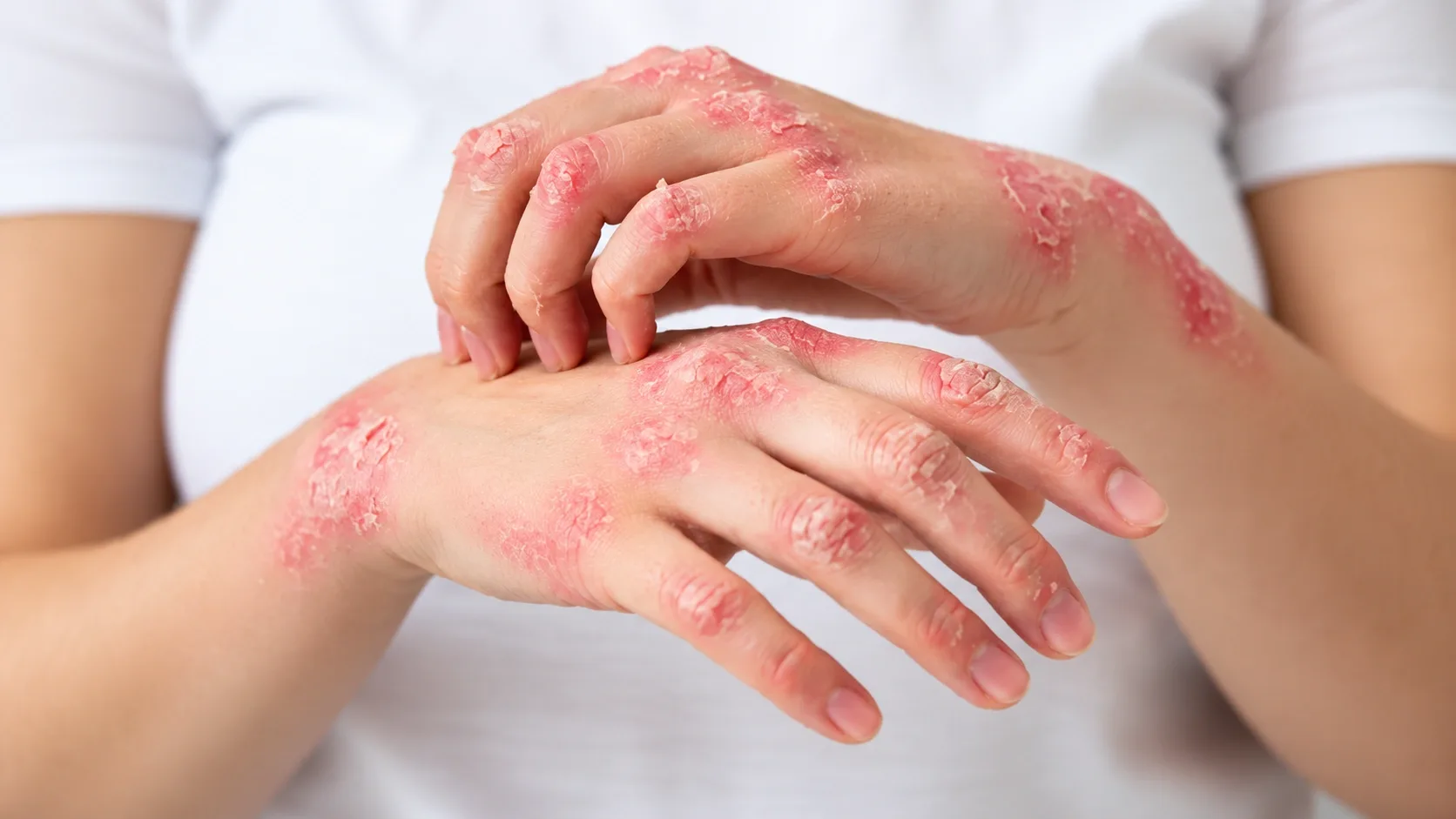 Psoriasis treatment in Dubai