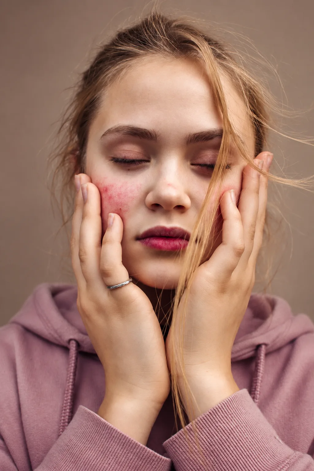 Rosacea