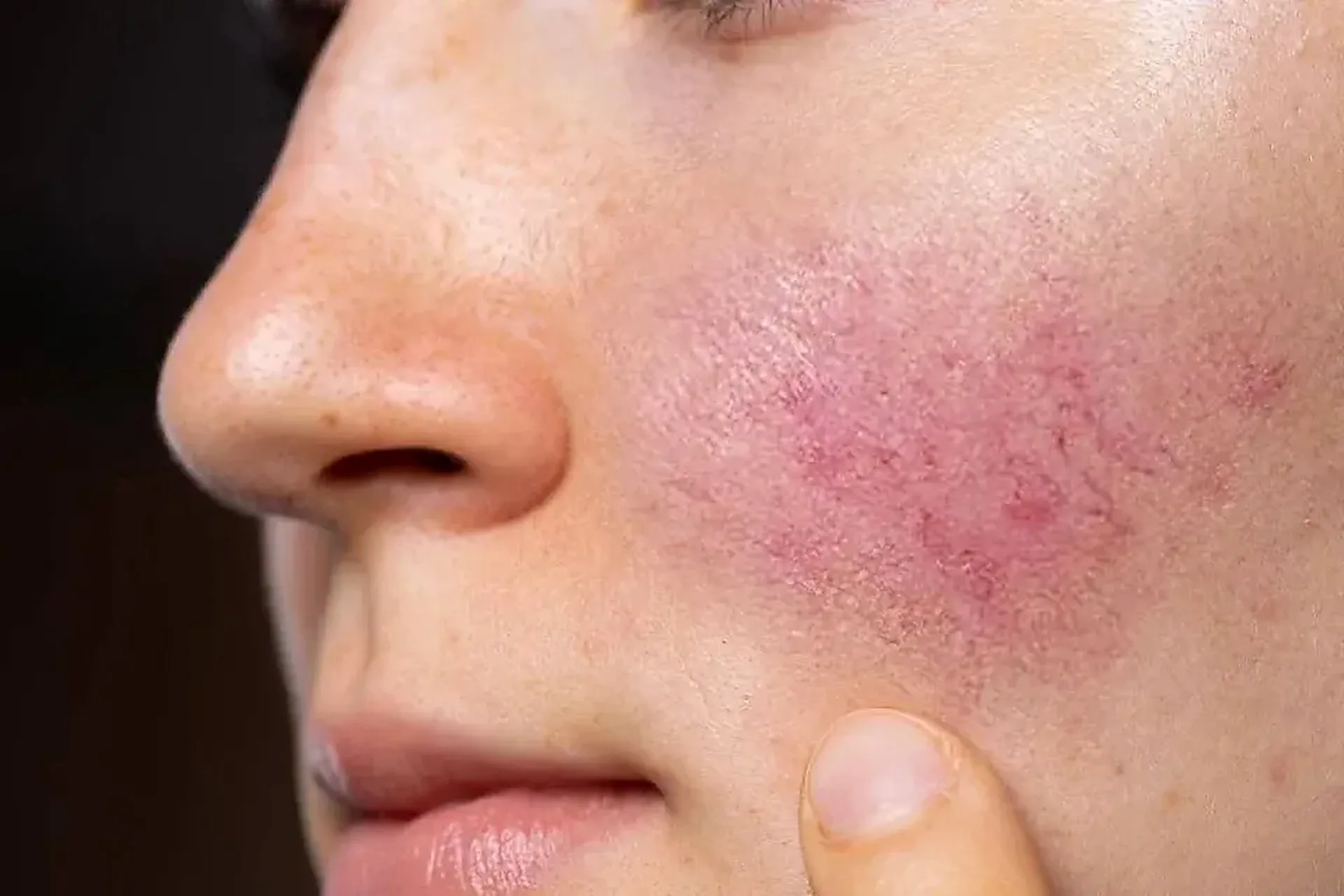 The main types of rosacea