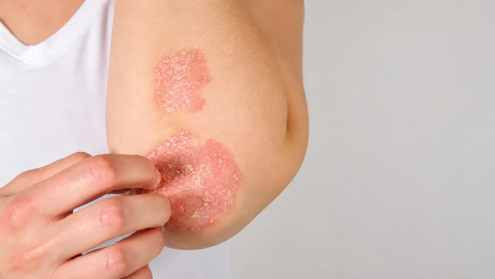 Skin Biopsy in Dubai