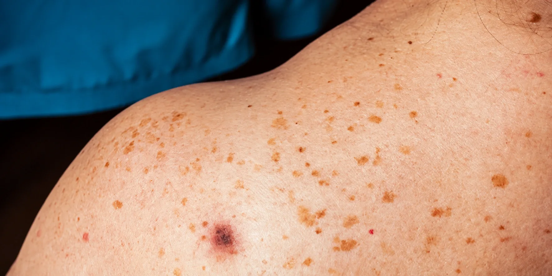 Skin Cancer Treatment in Dubai