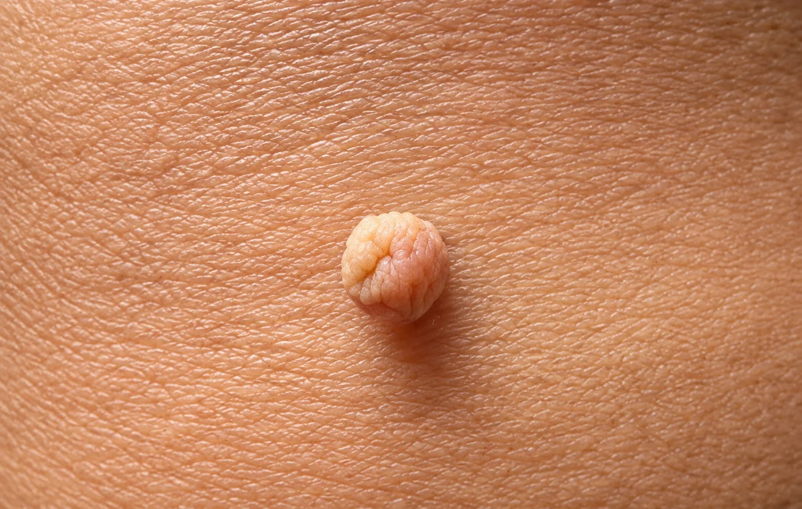 Who Needs Skin Tag Removal in Dubai?