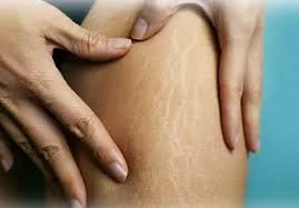 Can Stretch Marks Be Removed? Facts, Myths and Solutions