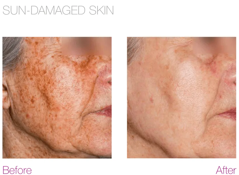 Types of Brown Spots on the Skin