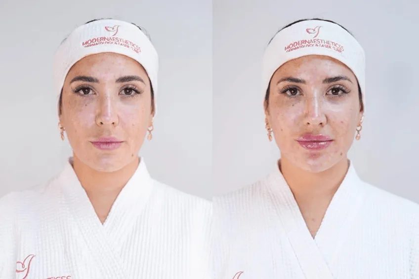 Treatment Results