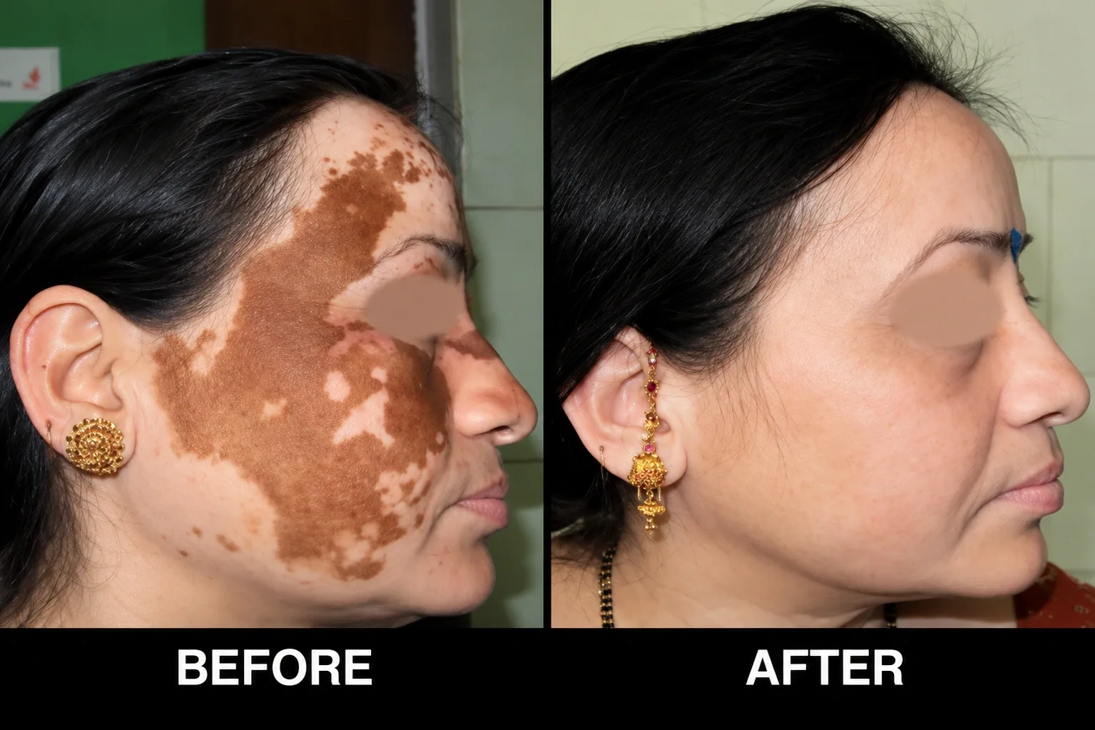 Why Vitiligo Treatment in Dubai Matters?