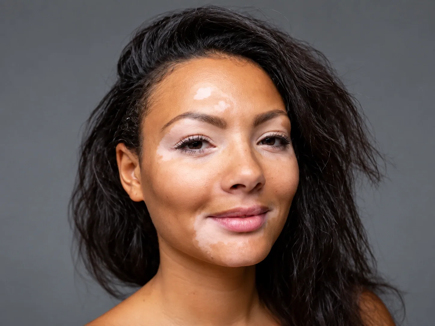 Vitiligo Treatment in Dubai​