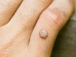 Healing & Aftercare of Warts Removal Dubai
