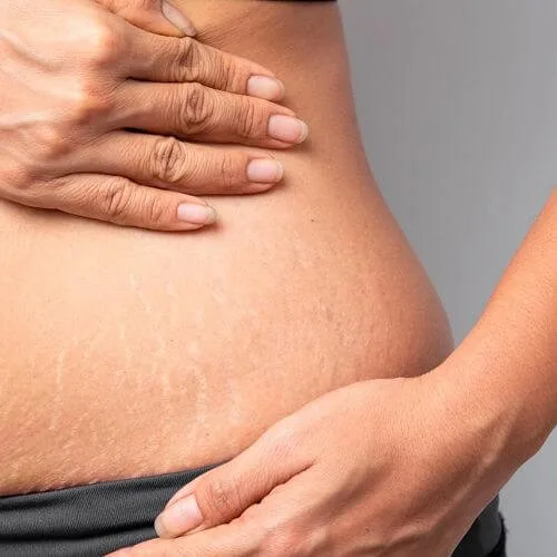 Stretch marks
