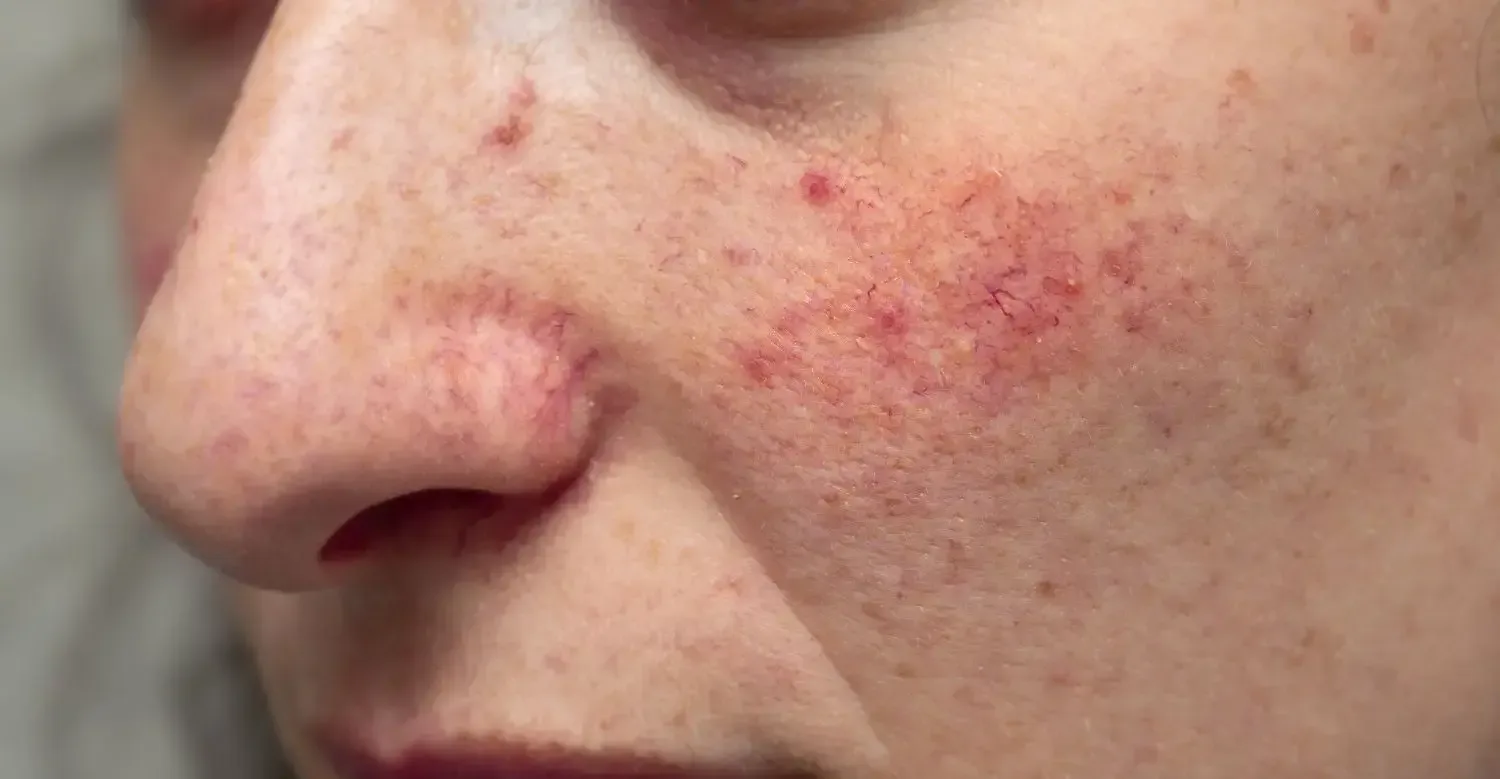 Rosacea: Symptoms, Causes, and Effective Treatments
