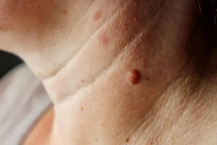 mole-removal-services